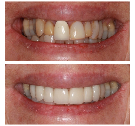 Dental Crowns Near You