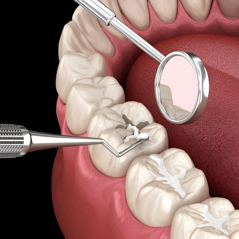 Dental Sealants Near You