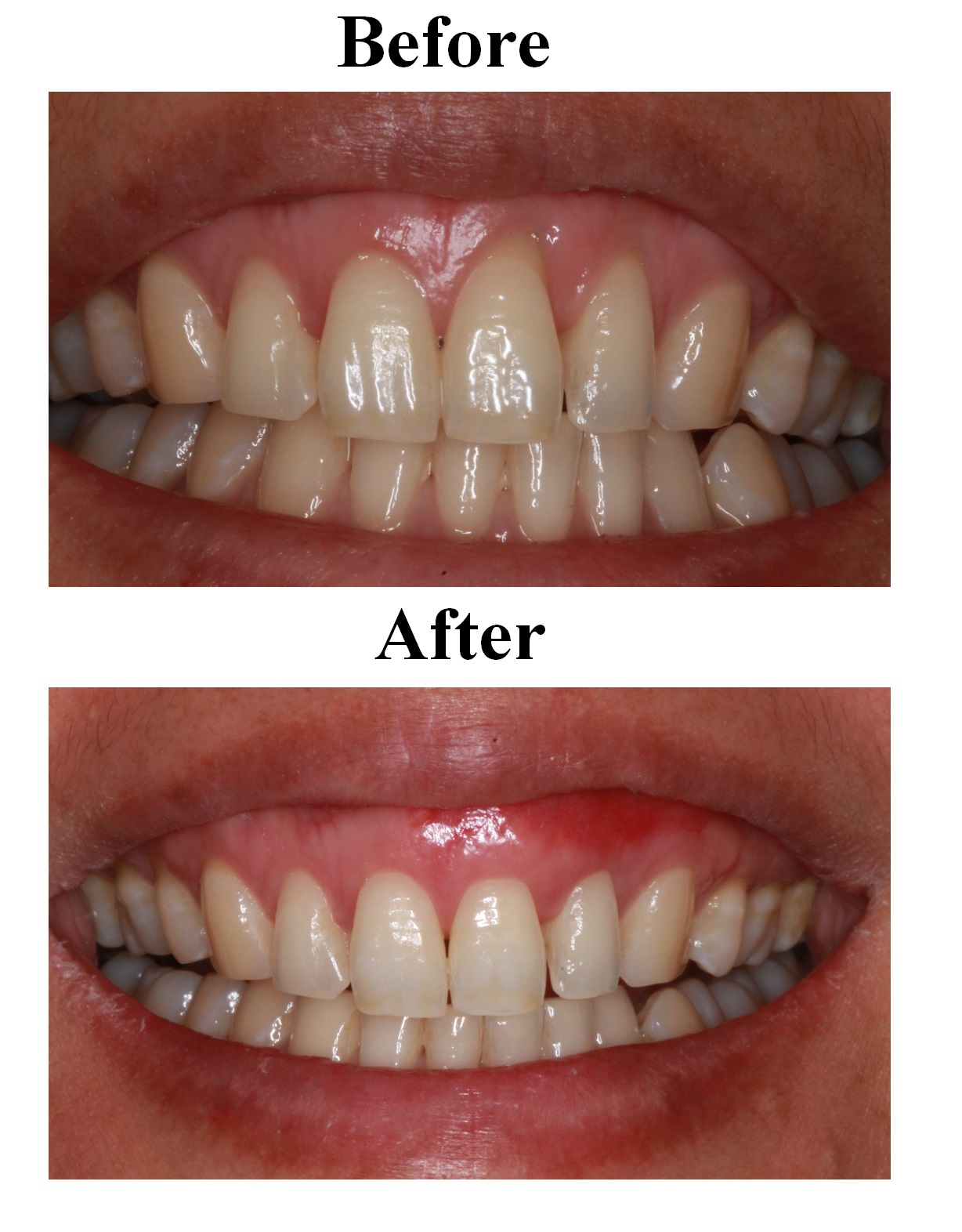 Gum and Bone Grafting Near You