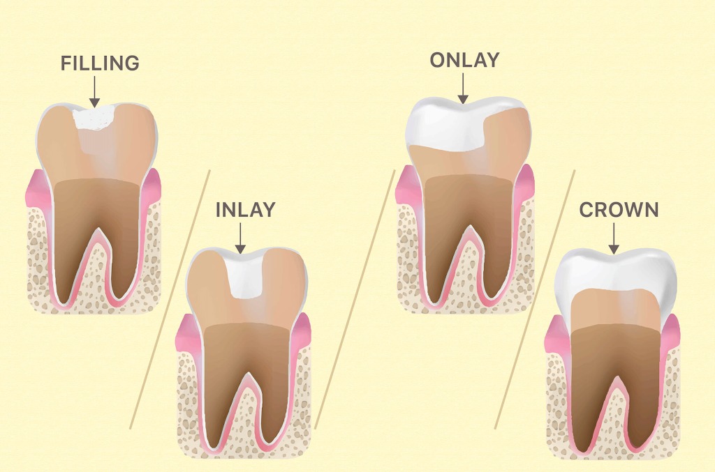 inlays and onlays near you