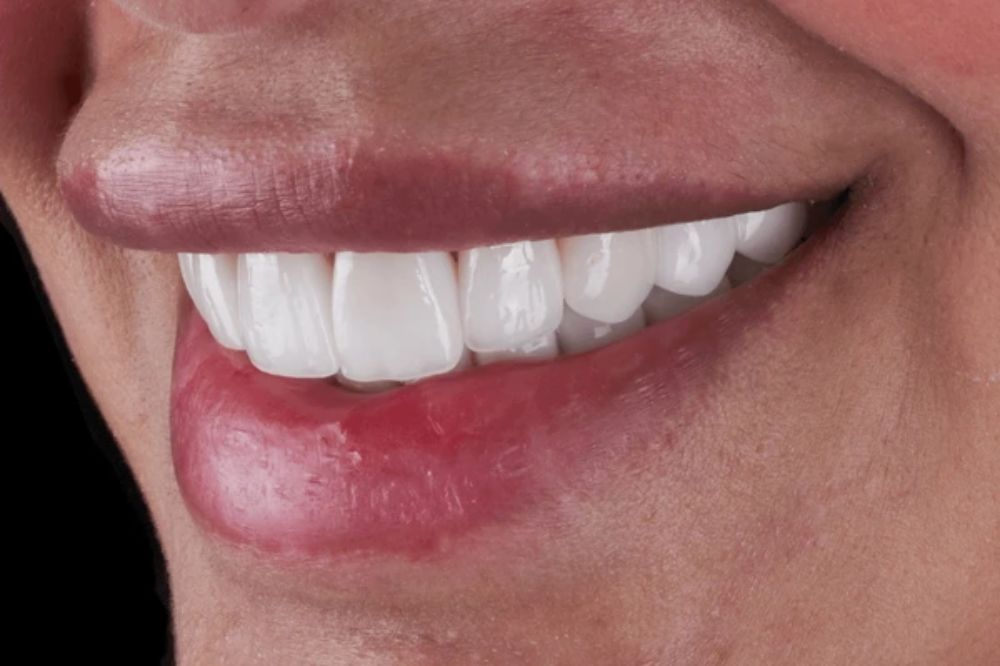 why teeth whitening is a popular cosmetic dentistry procedure