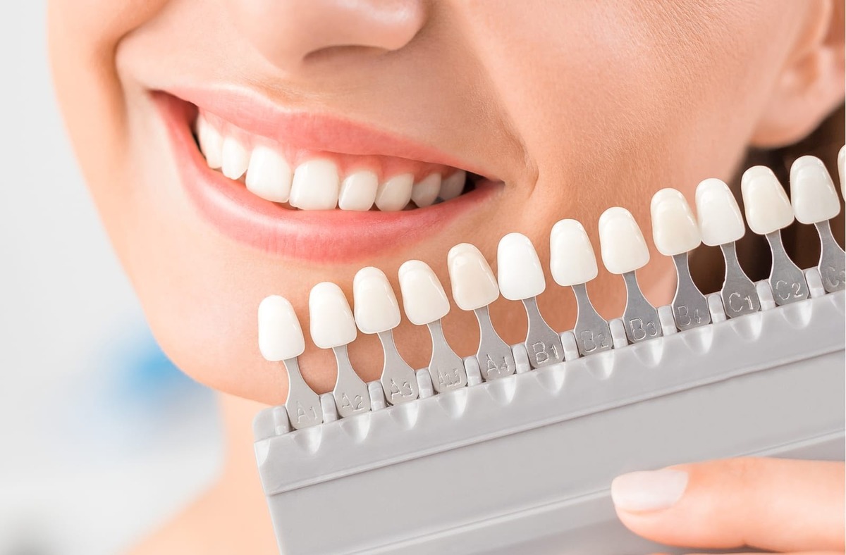 porcelain veneers durability